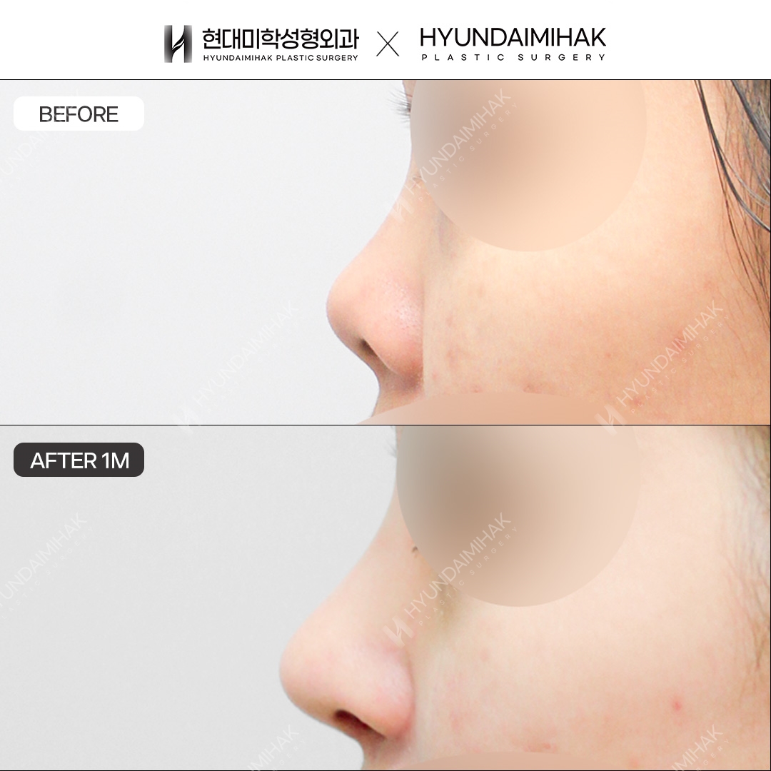 [Revision Rhinoplasty] Nasal bridge + nasal tip, 1 month post-op