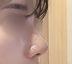 I Smashed My Hump Nose