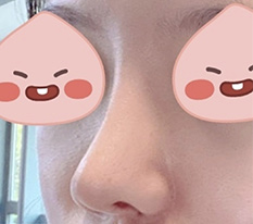 Finally hit 6 months after my nose revision surgery hh