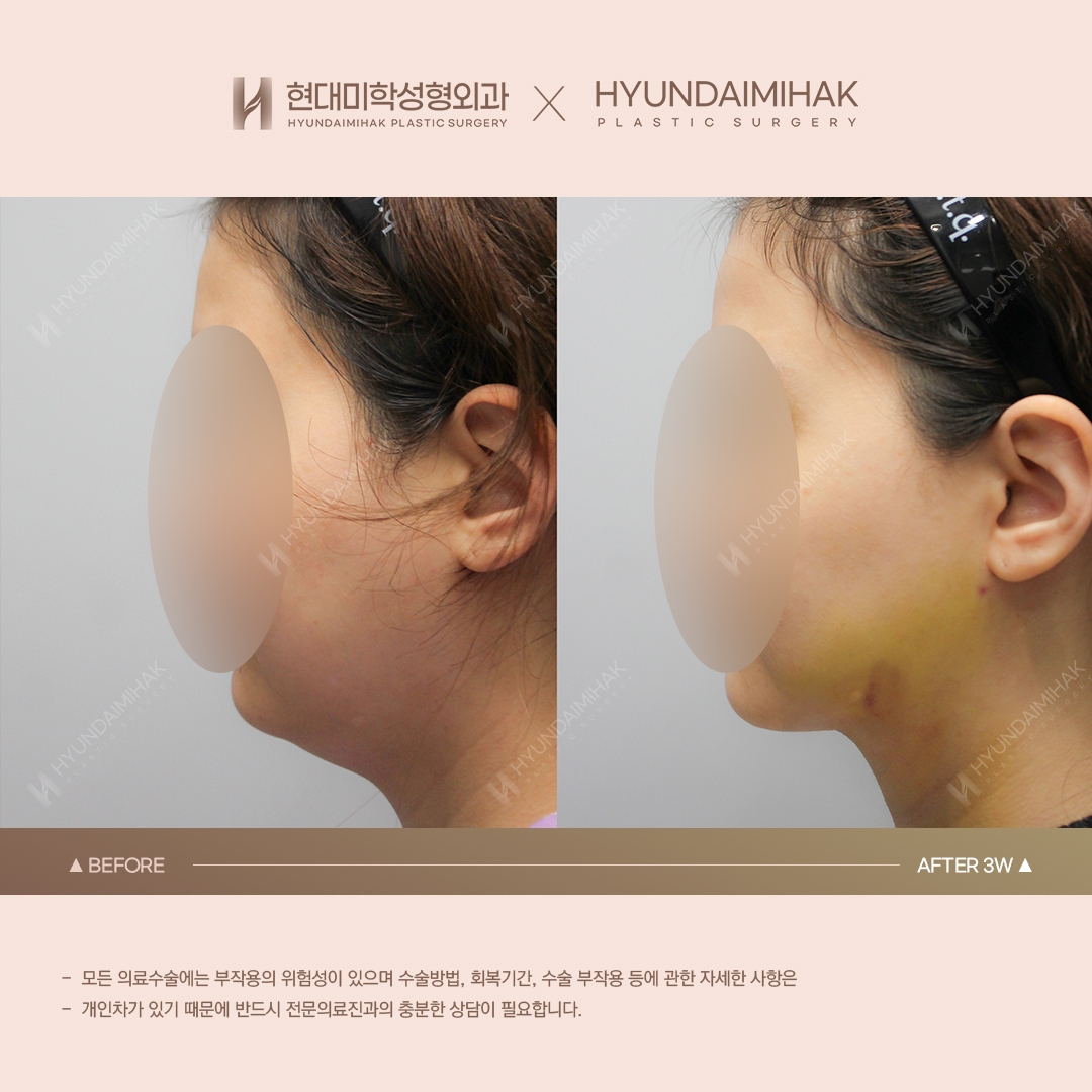 [Lifting] Double-Chin Thread Lift, Week 3