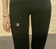 I had thigh liposuction~