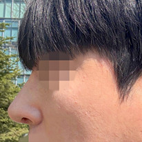 Male hump-nose surgery