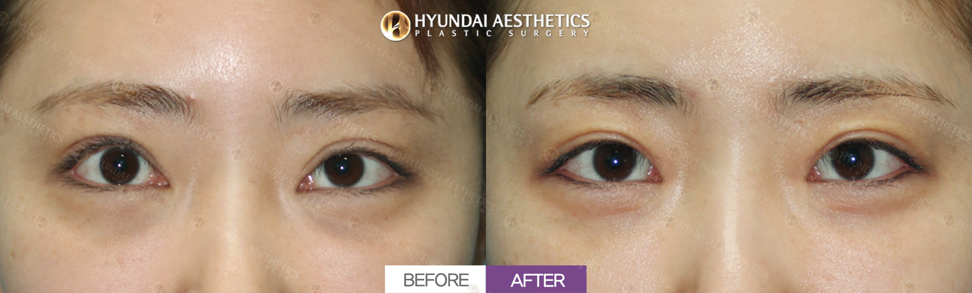Revision eye surgery (epicanthoplasty reversal + double eyelid surgery + ptosis correction), 1 month
