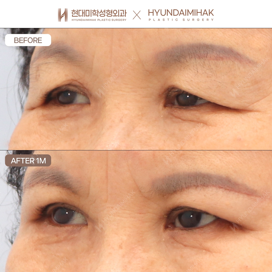 [Anti-Aging Surgery] Brow Lift, 1 Month