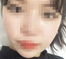 Cheekbone reduction