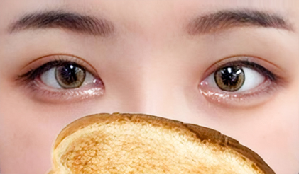 Revision eye surgery, revision double eyelids, epicanthoplasty restoration, lower and outer canthoplasty