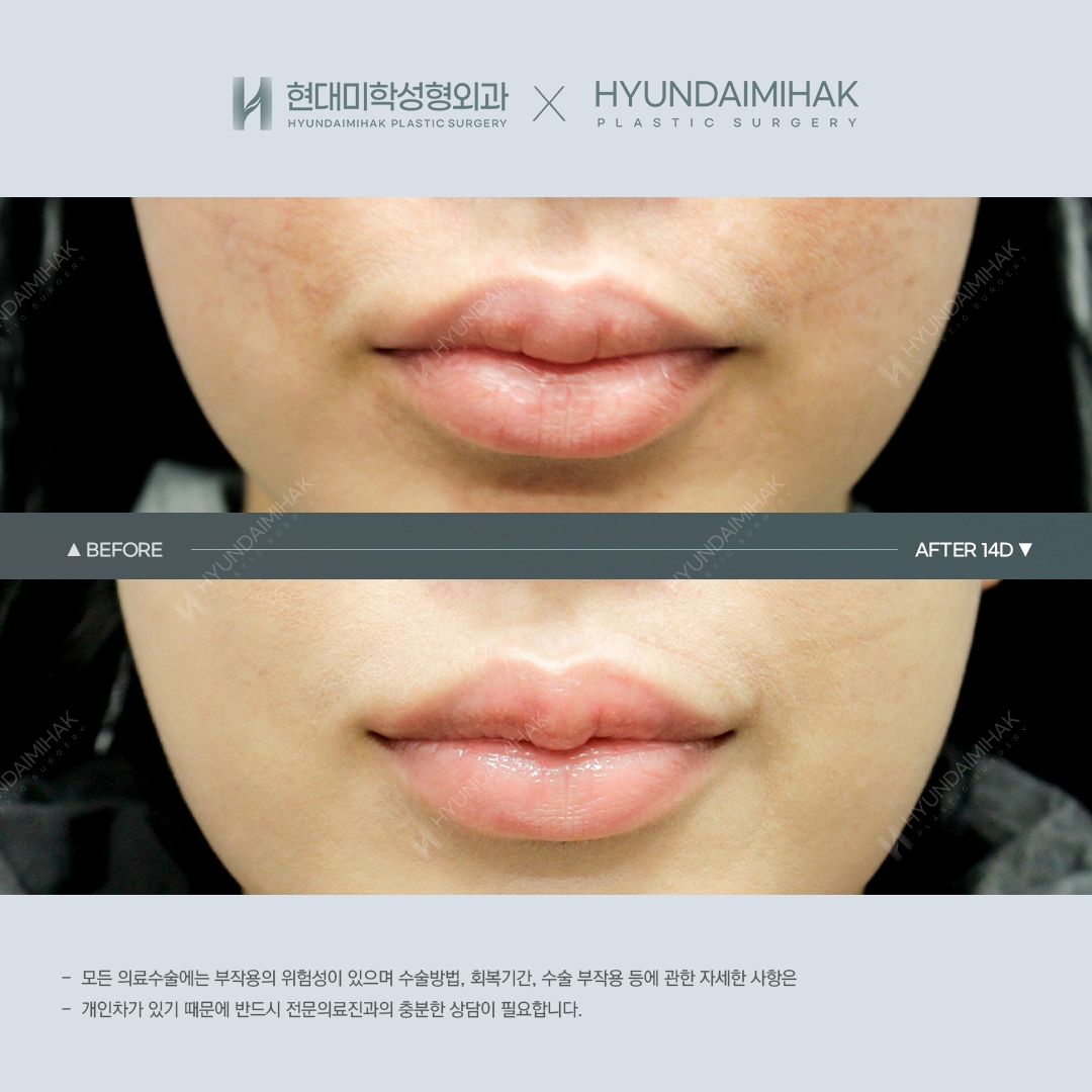 [Lip Surgery] Cupid Lip Surgery, Day 14
