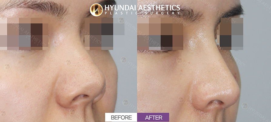 Short-Nose Rhinoplasty (Upturned-Nose Correction)