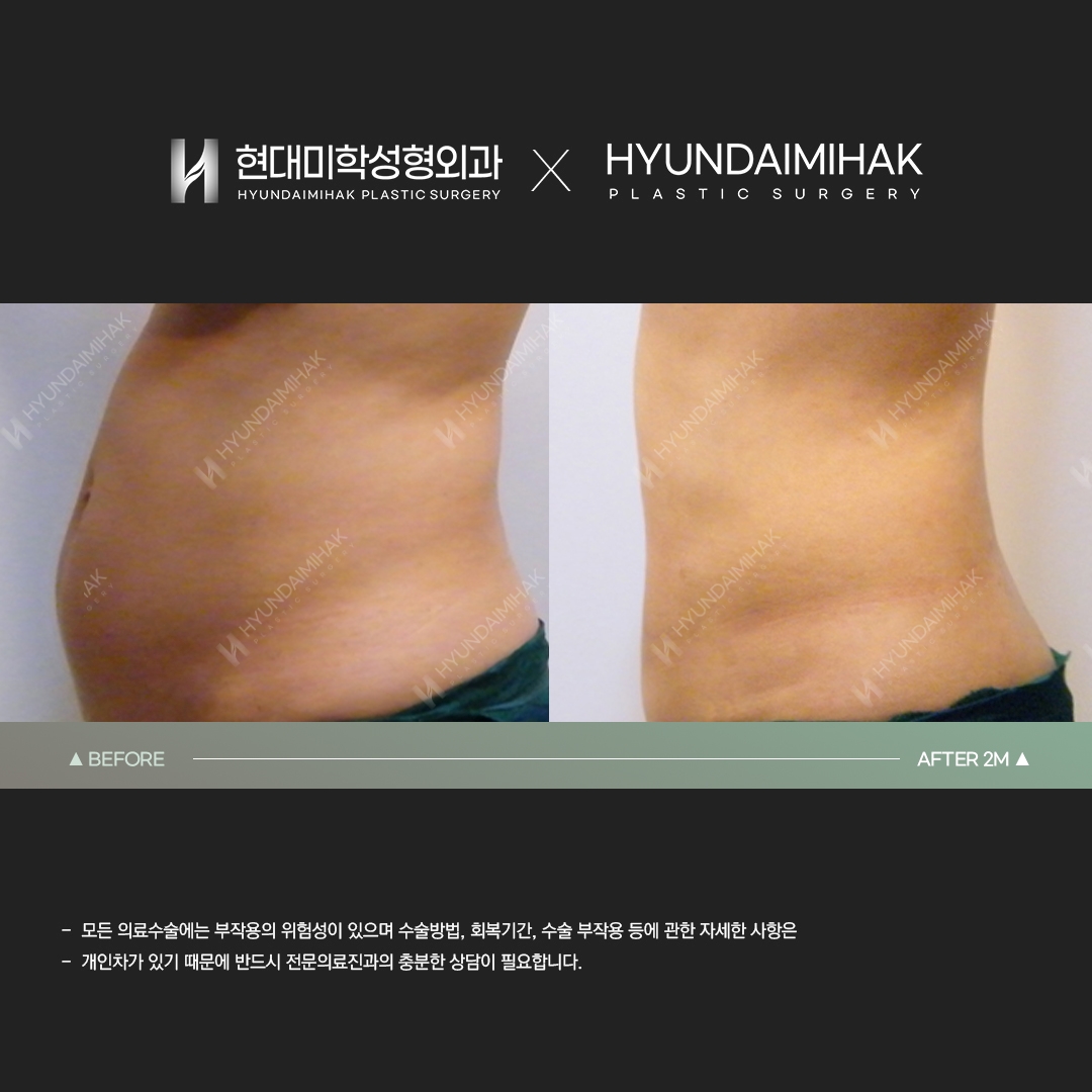 Abdominal liposuction, 2 months after surgery