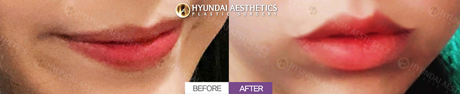Mouth Corner Lift