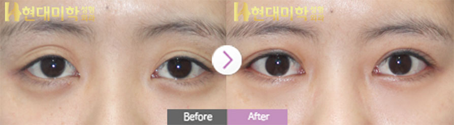 Revision Incisional Eye Surgery, Ptosis Correction, Outer Canthoplasty, Lower Canthoplasty
