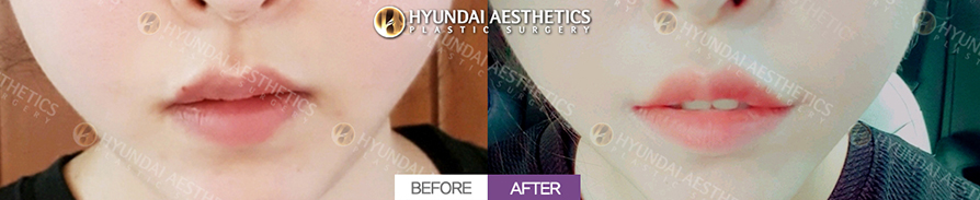 Mouth Corner Lift + Marionette Lines