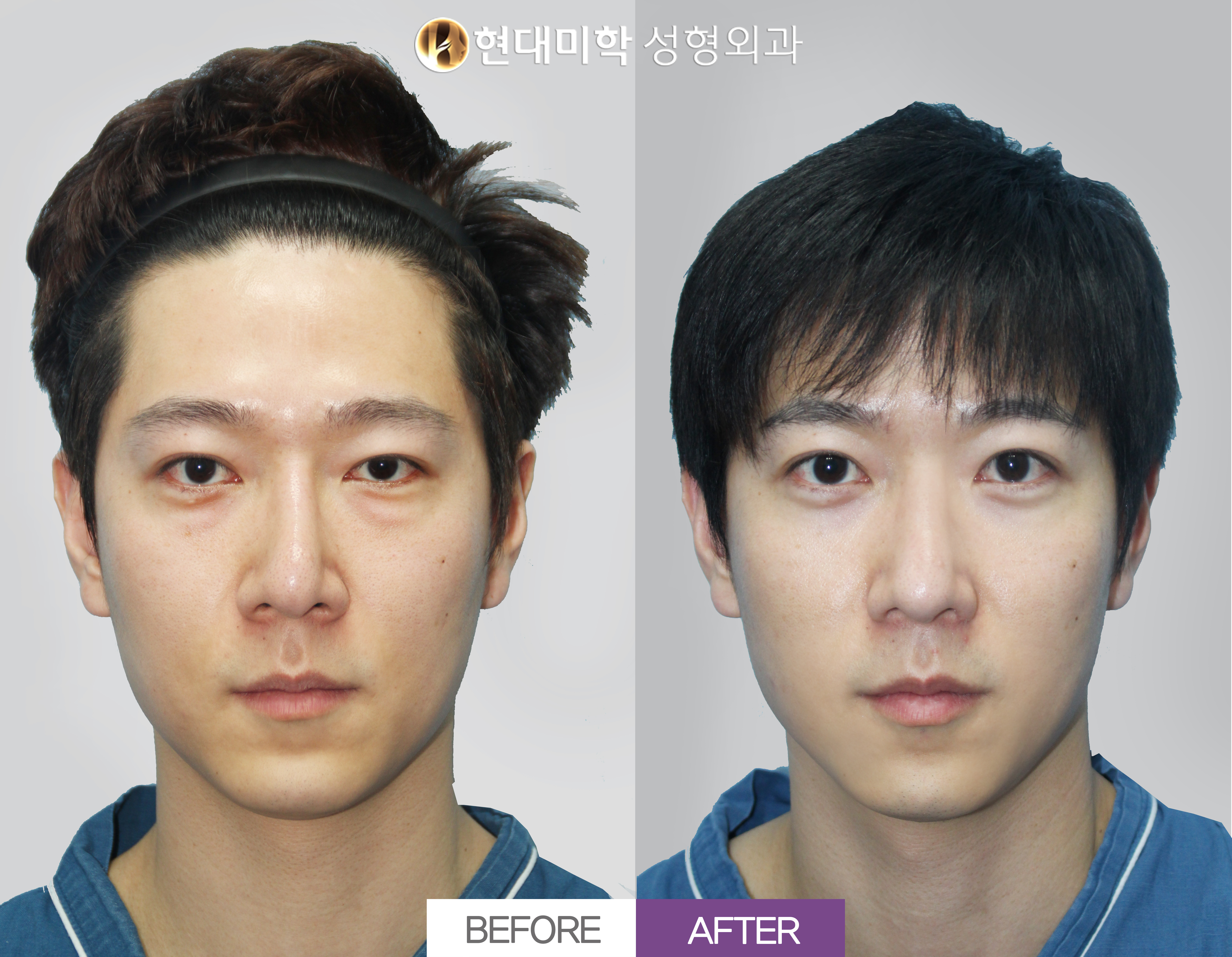 Men's Revision Rhinoplasty, 1 Month