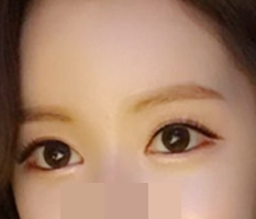My eyes got prettier after canthoplasty