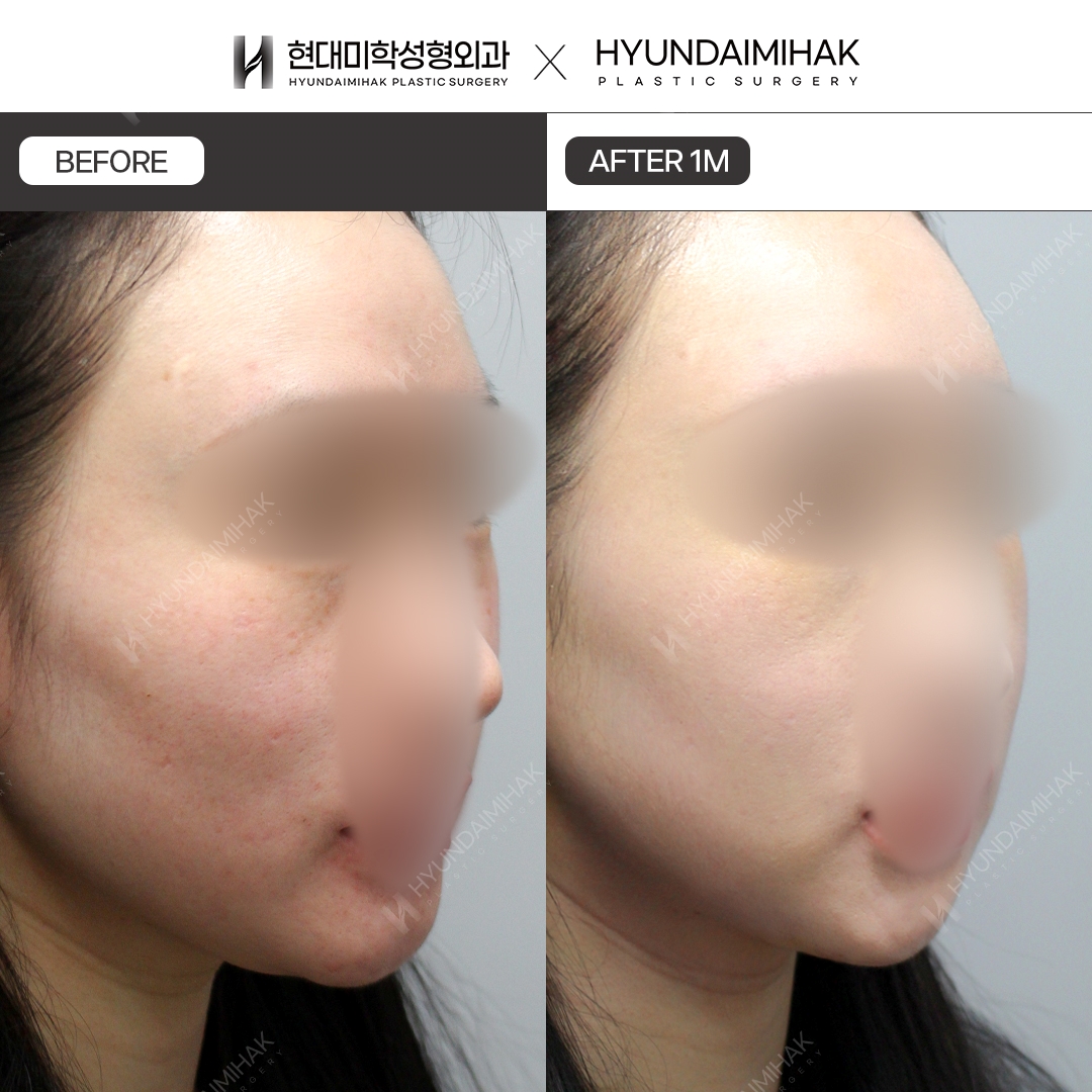[Facial Rejuvenation] Thread Lift, 1 Month Later