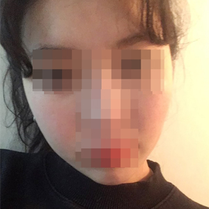 Just one cheekbone procedure and…