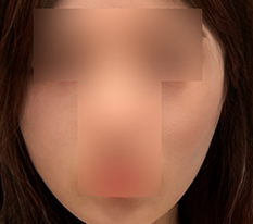 A slimmer face without surgery