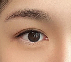 I Had Double-Eyelid Revision