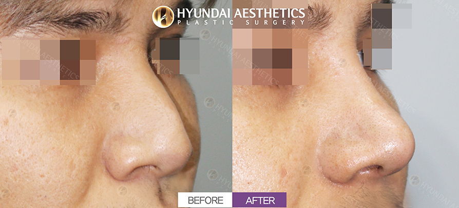 Hump Nose Rhinoplasty