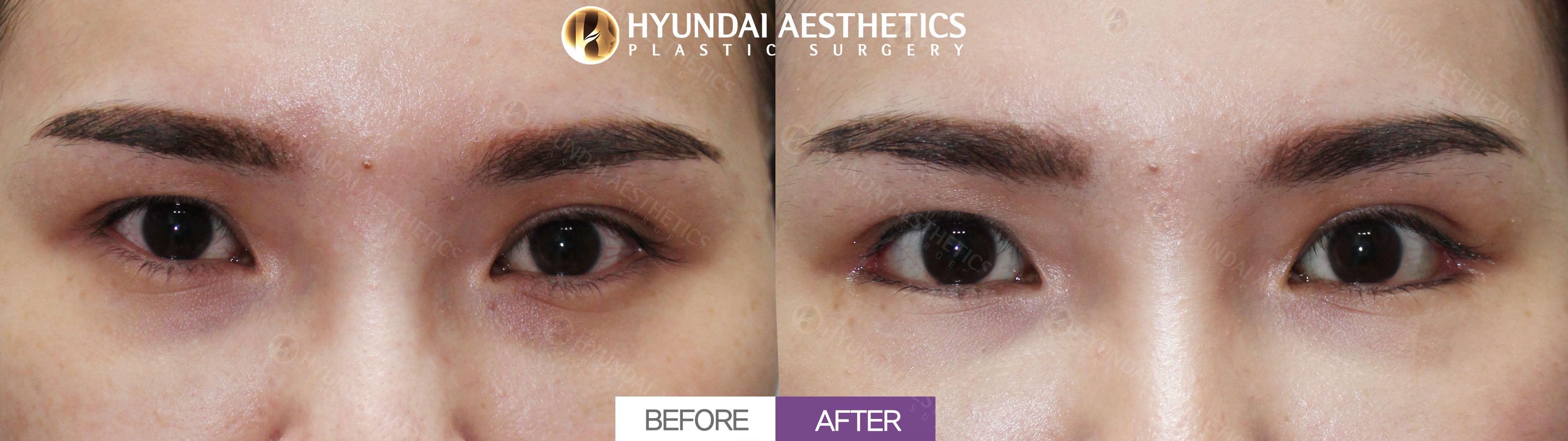 Dual Canthoplasty, 1 Month