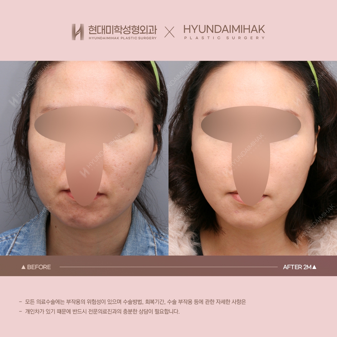 [Anti-Aging Surgery] Thread Lift, 2 Months