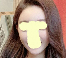 Posting my 5-month post-cheekbone surgery review~!