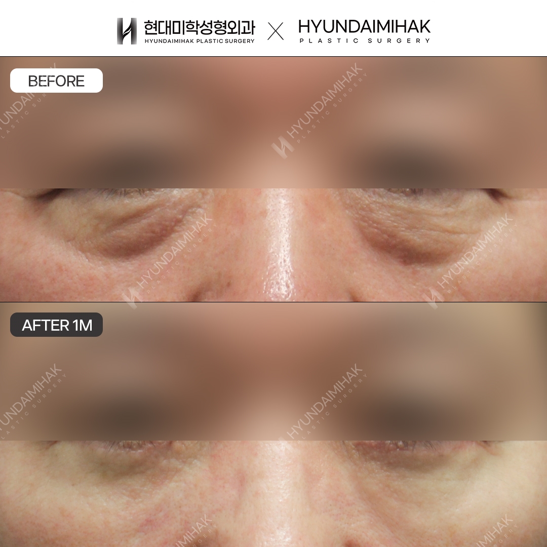 [Middle-aged Eye Surgery] Lower blepharoplasty
