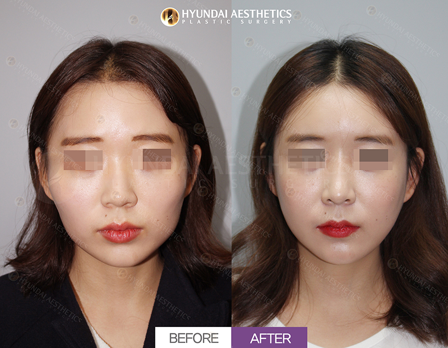 Cheekbone Reduction + Square Jaw Reduction