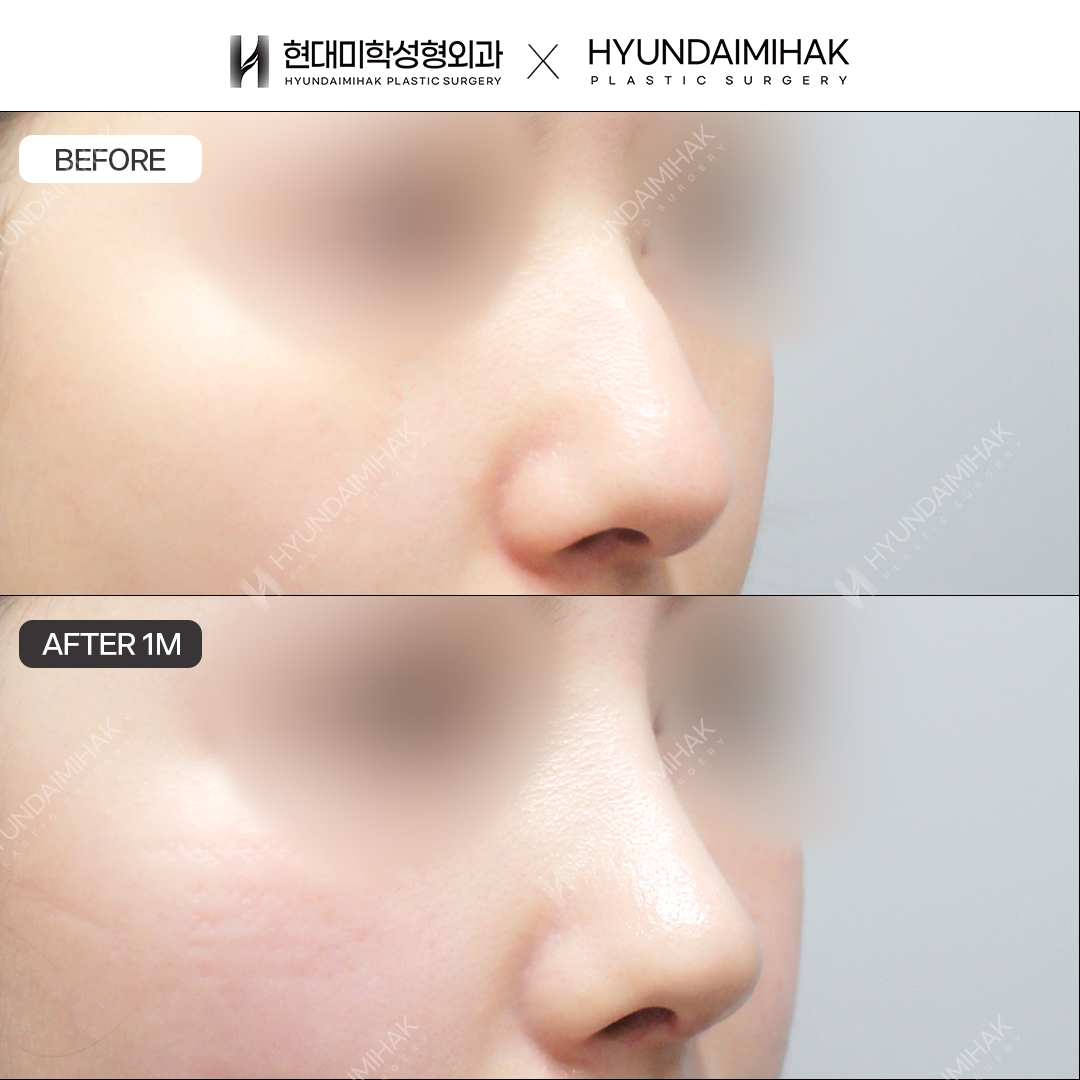 [Hump Nose Surgery] Bridge + Tip, 1 Month