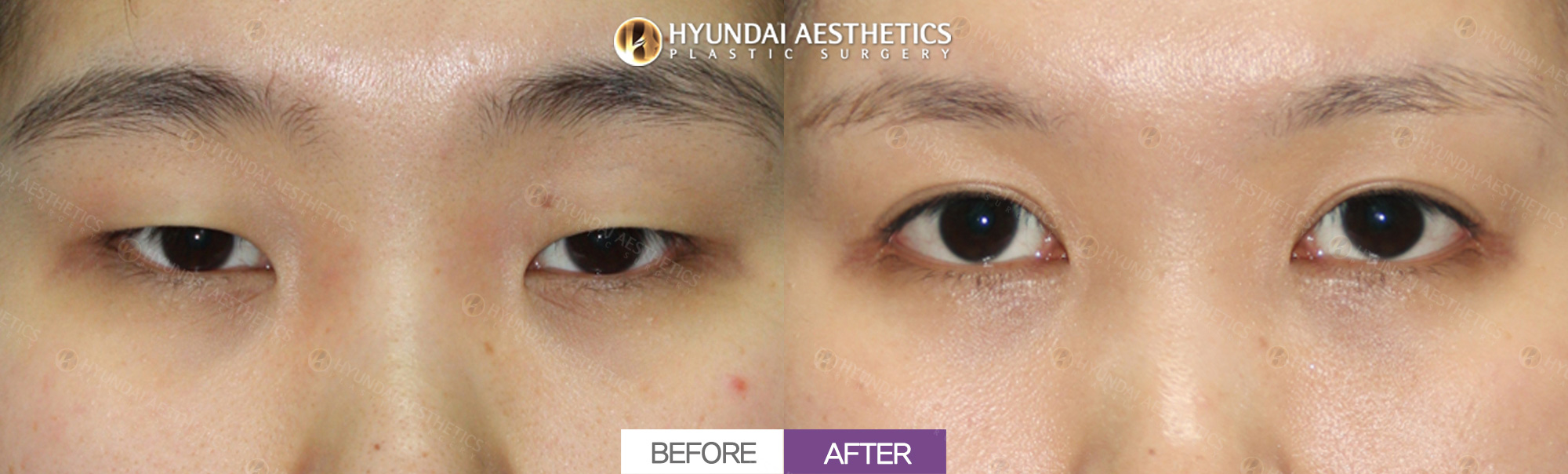 Revision incisional surgery + ptosis correction + epicanthoplasty + dual canthoplasty