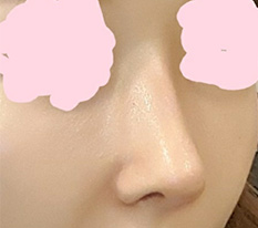 I am bragging everywhere about my nose surgery hehe