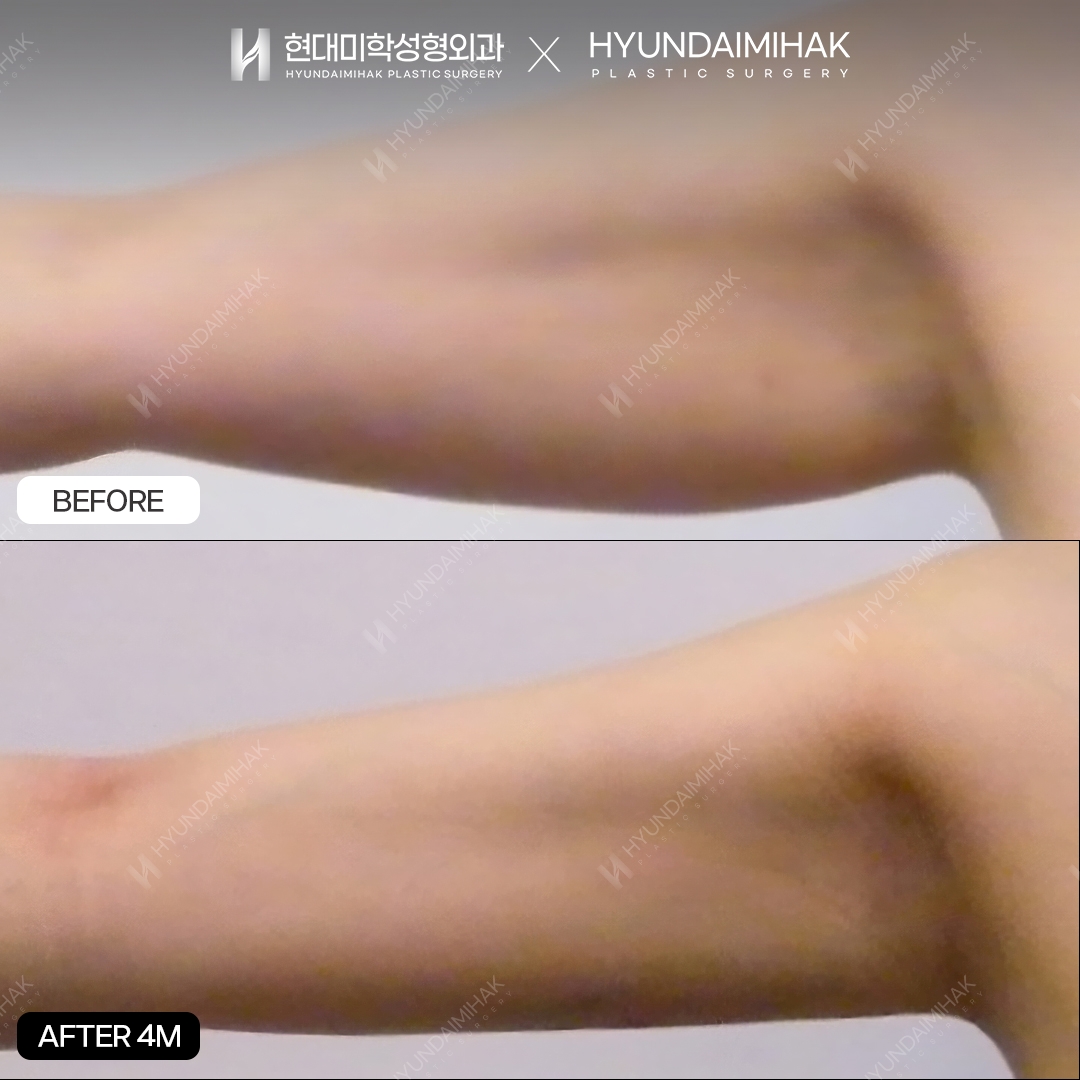 Arm liposuction, 4 months post-op