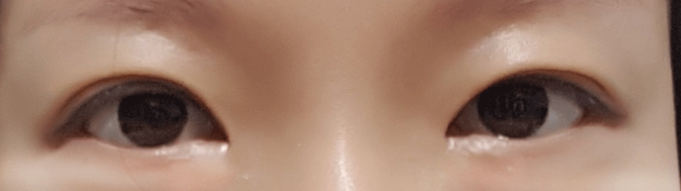 Incisional eye correction / epicanthoplasty 1-month review~