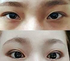 My forehead lift turned out so well that I came to leave a review haha
