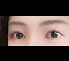 Revision double-eyelid surgery to lower uneven eye lines