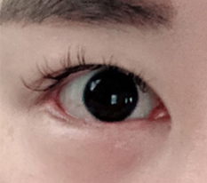 10000% satisfied with revision lateral and lower canthoplasty