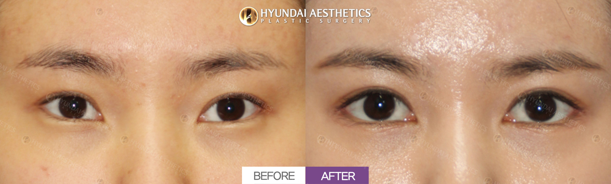 Eye Revision Surgery (Non-incisional Ptosis Correction + Double Eyelids + Lateral Canthoplasty + Lower Canthoplasty), 1 Month