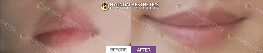 Mouth Corner Lift + Marionette Lines