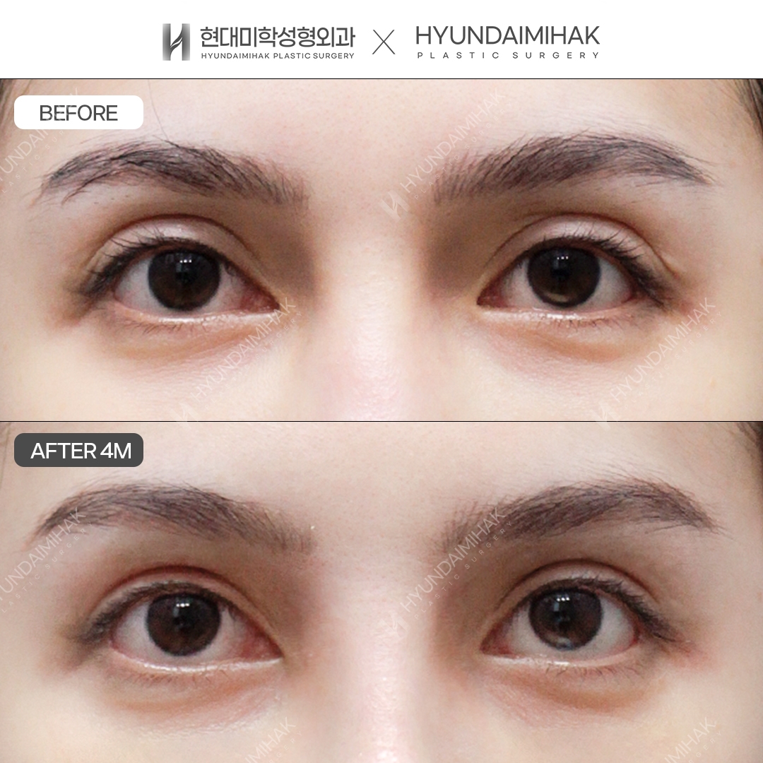 [Revision Eye Surgery] Lowering the Crease