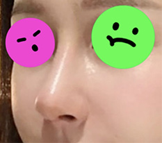 A month after nose surgery and totally satisfied^^