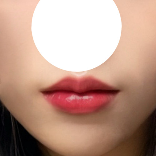 I had lip surgery at Hyundai Aesthetic Surgery