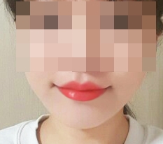 Cupid mouth corners + lip tubercles