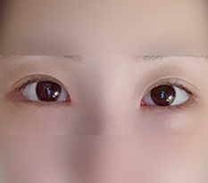 So this is why people get dual canthoplasty lol