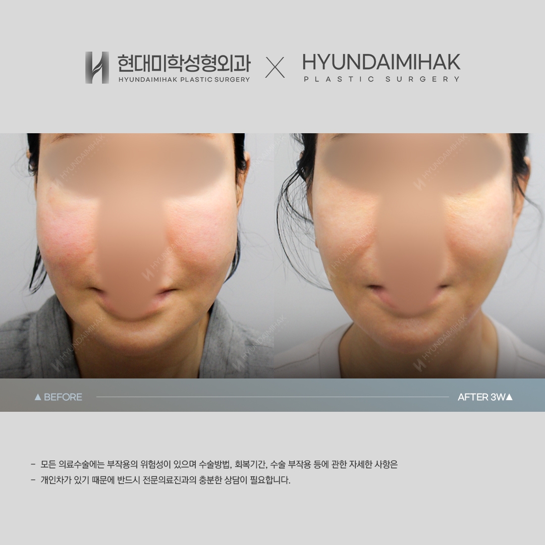 [Anti-aging Surgery] Thread lift, 3 weeks