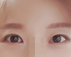 The Eye Surgery That Was a Stroke of Genius