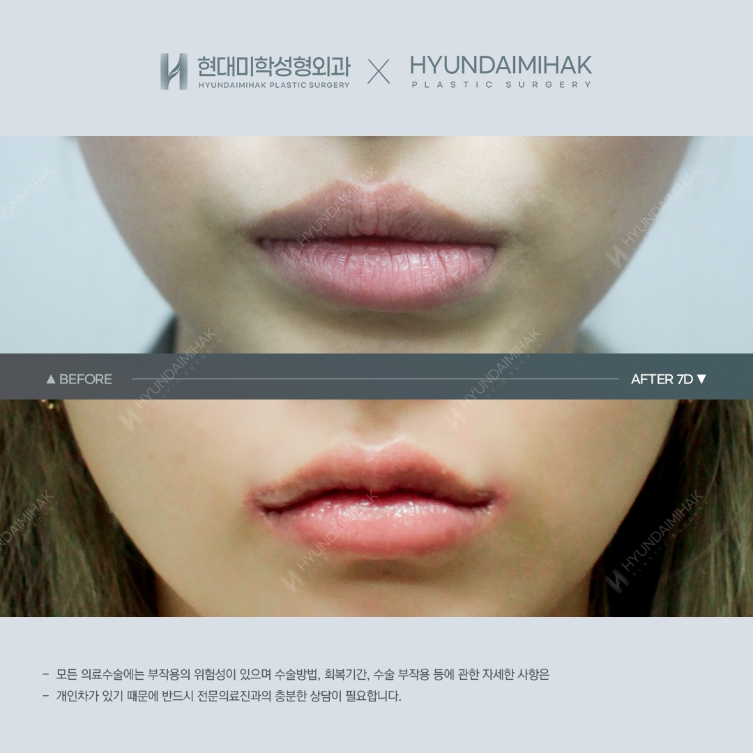 [Lip Surgery] Cupid's Bow Line and Asymmetry Correction, Day 7