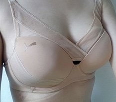 My review of breast lift correction at Hyundai Aesthetic Surgery