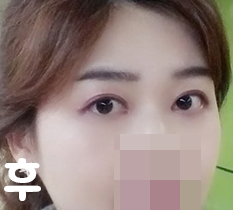 Successful eye revision surgery^^