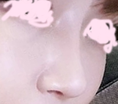 My rhinoplasty revision review~