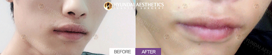 Upper Lip Reduction